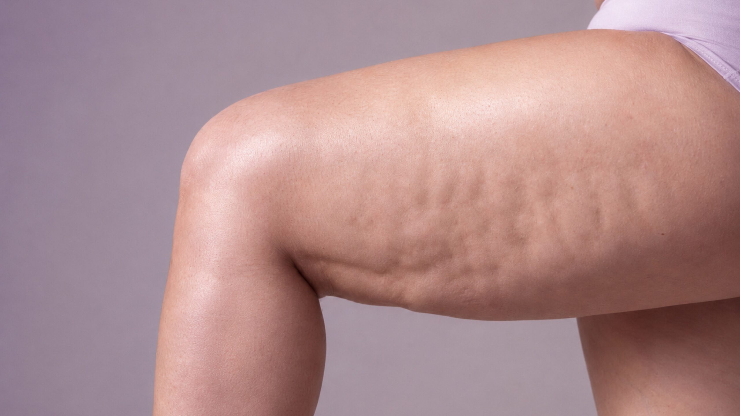 O Impacto da Fisioterapia Dermatofuncional no Tratamento de Lipedema